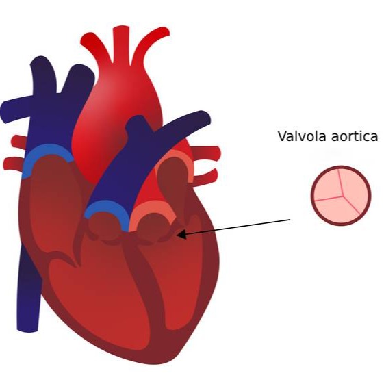 Valvola aortica bicuspide