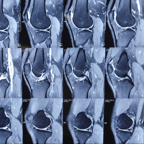 Condrosarcoma